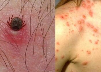 Estatus actual de Fiebre Manchada por Rickettsia rickettsii (FMRR) en Sonora