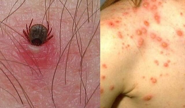 Estatus actual de Fiebre Manchada por Rickettsia rickettsii (FMRR) en Sonora