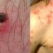 Estatus actual de Fiebre Manchada por Rickettsia rickettsii (FMRR) en Sonora