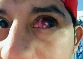 Joven perderá un ojo tras observar sin ninguna protección el eclipse solar.