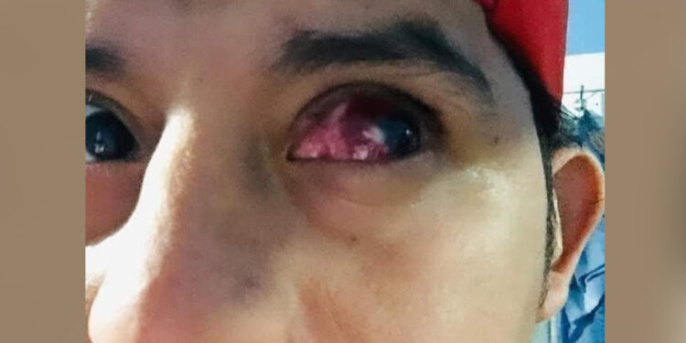 Joven perderá un ojo tras observar sin ninguna protección el eclipse solar.