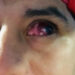 Joven perderá un ojo tras observar sin ninguna protección el eclipse solar.
