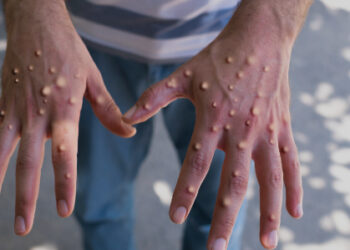 Afirma OMS la viruela del mono «no es el nuevo covid, sabemos enfrentarlo»