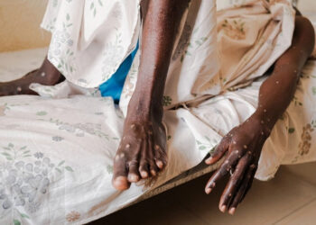 Inicia en Ruanda primera campaña de vacunación contra mpox en África