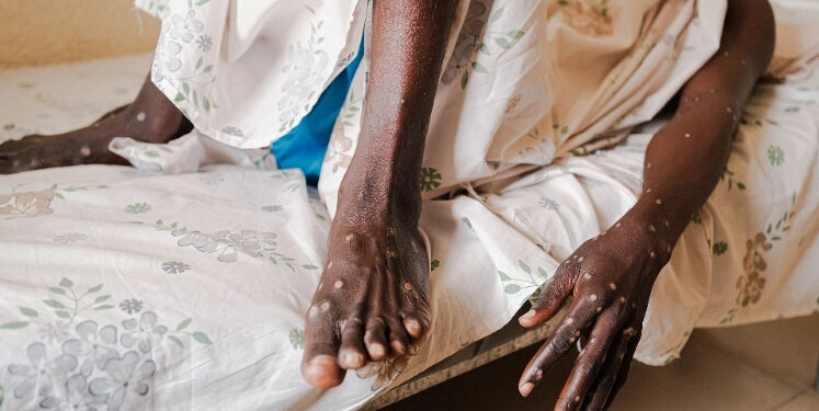 Inicia en Ruanda primera campaña de vacunación contra mpox en África