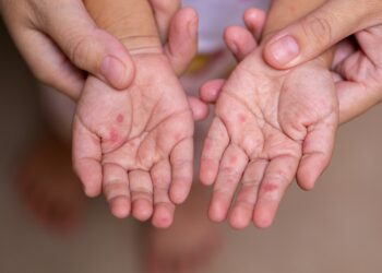 Casos de sarampión aumentan en Chihuahua