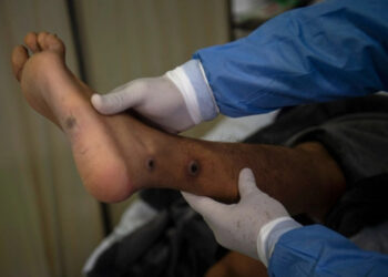 Paciente posiblemente contagiado de viruela símica ingresa a hospital de QR